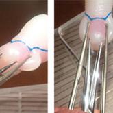 Intra-amniotic sludge: Does its presence rule out cerclage for short cervix?