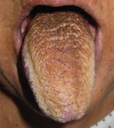 Black hairy tongue cured concurrently with respiratory infection