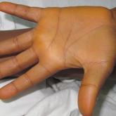 Carotenoderma Associated With a Diet Rich in Red Palm Oil