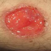 Secondary Syphilis: An Atypical Presentation Complicated by a False Negative Rapid Plasma Reagin Test