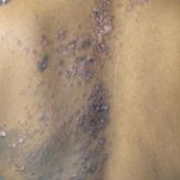 Discoid Lupus Erythematosus Following Herpes Zoster