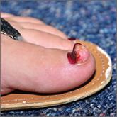 Enlarging nodule under the toenail • no history of trauma • unremarkable medical history • Dx?