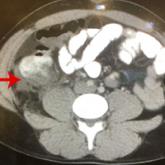 Gone but Not Forgotten: Acute Appendicitis Postappendectomy