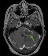 Central nervous system lymphoma mimicking Bell palsy