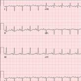 A (Not So) Humerus Situation