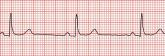 Bradycardia guideline sets new bar for shared decision-making in pacemaker placement