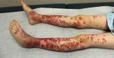 IgA vasculitis may be more common in adults than assumed