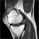 Managing atraumatic meniscal tears in middle-aged patients