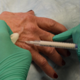 Hand Rejuvenation With Calcium Hydroxylapatite