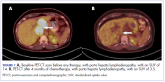 Prolonged survival in adenocarcinoma of unknown primary treated with chemoradiotherapy