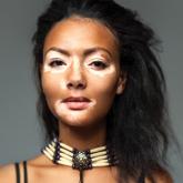 Is Vitiligo in Vogue? The Changing Face of Vitiligo