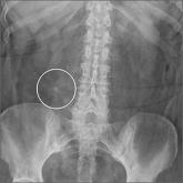 Chronic diarrhea in a 64-year-old woman