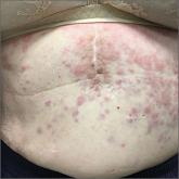 Persistent, asymptomatic rash