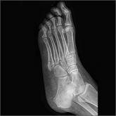 Proximal fifth metatarsal Jones fracture