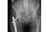 Bisphosphonate-related atypical femoral fracture: Managing a rare but serious complication