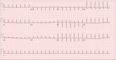 What Caused Patient’s Palpitations?