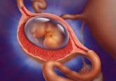 Medical Management of Ectopic Pregnancy: Early Diagnosis is Key