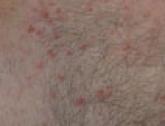 Chemotherapy-Induced Inflammatory Seborrheic Keratoses in a Man With Acute Myeloid Leukemia: A Variant of Leser-Trélat Sign?