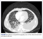 Bilateral chylothorax in an AIDS patient with newly diagnosed Kaposi sarcoma
