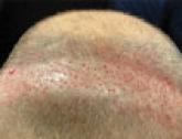 Hair Transplantation