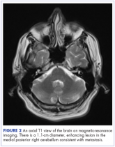 Intramedullary spinal cord and leptomeningeal metastases presenting as cauda equina syndrome in a patient with melanoma