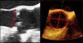 3-D TEE More Accurate Than 2-D in Aortic Annulus Measurement