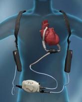LVADs for Severe Heart Failure Gradually Take Hold