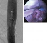 PRESERVE gets to the heart of IVC filters