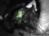 Green glow the tumors during surgery