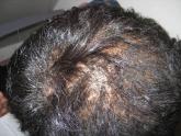 Diagnosing hair loss in black patients starts with right questions