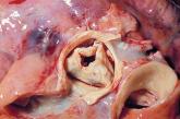 New valve guideline promotes early surgery