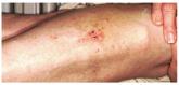 Is This Man's Eczema Spreading?