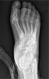 Foot Pain Following a Car Crash