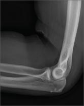 A Different Source of Elbow Pain