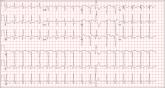 Chest Pain and Vomiting with Prior Heart Attack