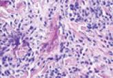 Wells Syndrome