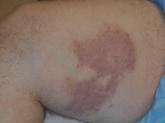 Indurated Thigh Plaque With Associated Lymphadenopathy