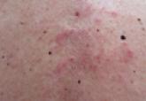 Reticular Erythematous Mucinosis on the Midline of the Back