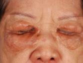 Yellowish Papulonodular Periorbital Eruption