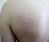 Atrophic Plaques on the Back 