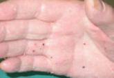 Acitretin-Induced Acral Hemorrhagic Lesions in Darier-White Disease
