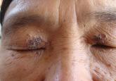 Late-Onset Nevus Comedonicus on Both Eyelids With Hypothyroidism