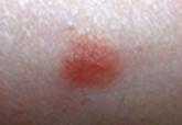 Targetoid Hemosiderotic Hemangioma: A Case Report of Multiple Asymptomatic Lesions