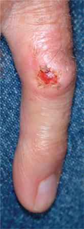 40 Year Old "Wart" Suddenly Changes