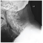 Man with Decreasing Consciousness and Increasing Confusion