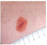 What is the Next Step in Dealing With This Lesion?