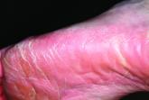 30-Year Rash that Flares in the Summertime