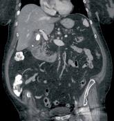 Epigastric abdominal pain