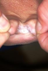 "Athlete's Foot" That Won't Go Away