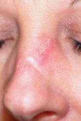 Woman Worried Skin Change May Produce Scars